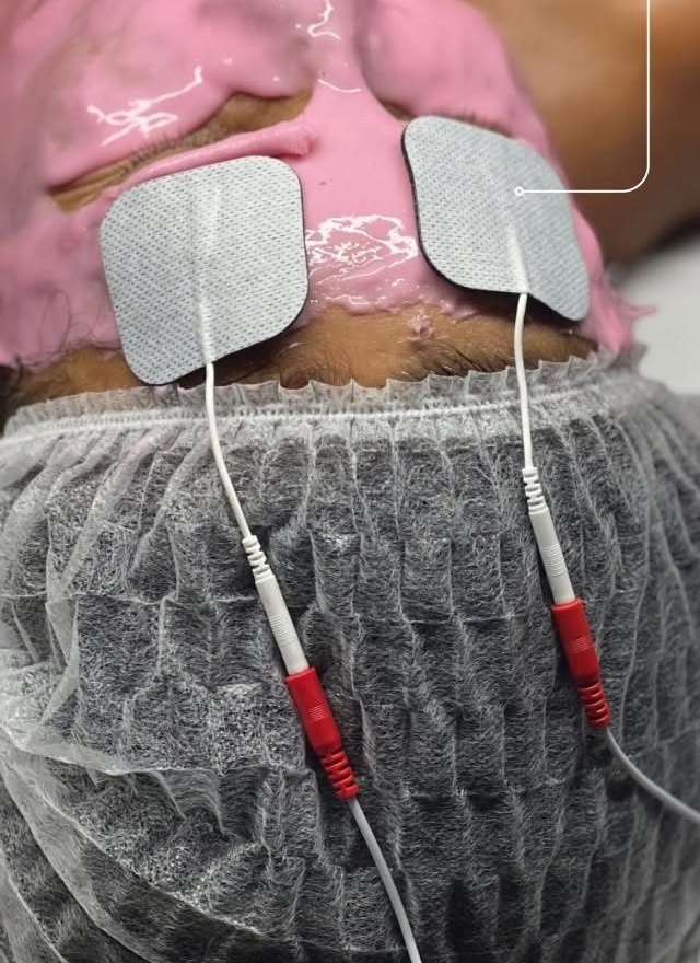 Électrodes posées sur un masque rose, reliées à l'appareil d'ionophorèse